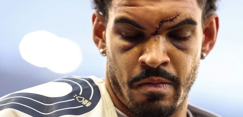Joueur avec des blessures au visage avant le match